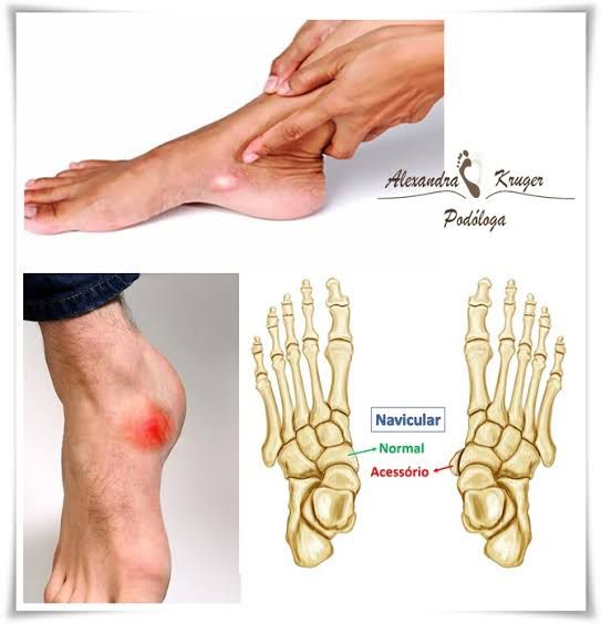 Síndrome de MüllerWeiss causa necrose no nosso navicular Sem Barreiras
